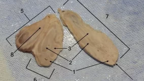 Strange Case Of A Man With Three Penises Discovered